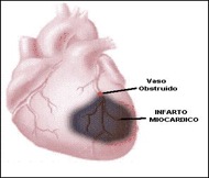 ¿Qué es y cómo prevenir un infarto agudo de miocardio?