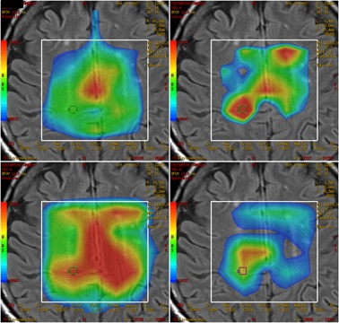 Ventajas del Resonador 3 Tesla (alto campo) en el estudio de patologías invalidantes