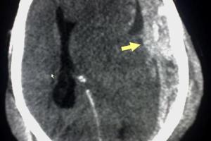 Tratamiento del hematoma subdural crónico