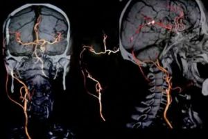 Bypass cerebral de alto flujo con vena safena interna