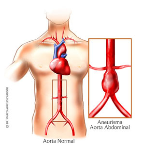 Aneurisma de Aorta Abdominal: un enemigo silencioso
