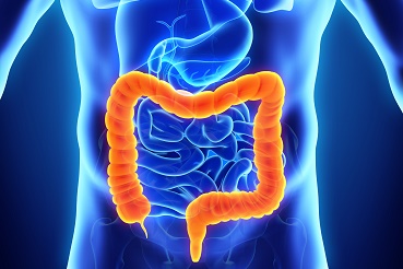 Cáncer de Colon: Preguntas y Respuestas