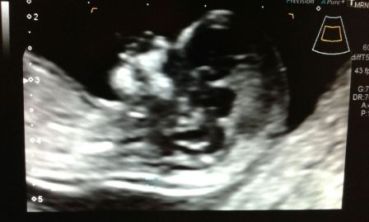 Translucencia nucal: ¿De qué se trata?