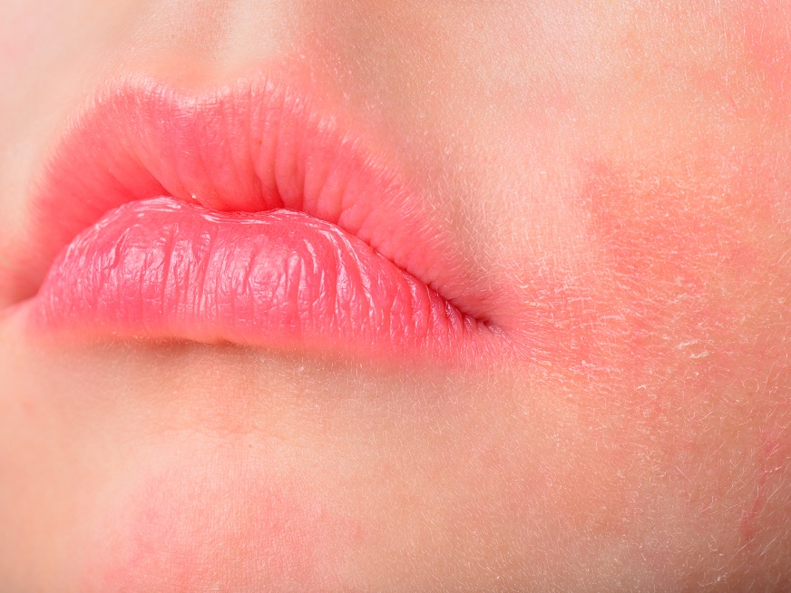 Urticaria y Angioedema: causas y características