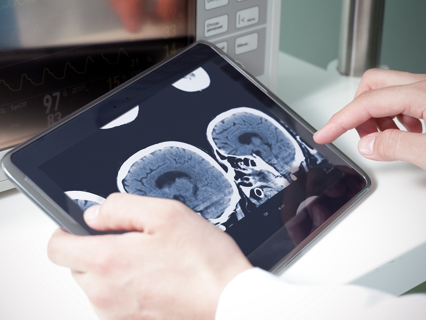 ACV: "En la rehabilitación integral no hay techo para el paciente"