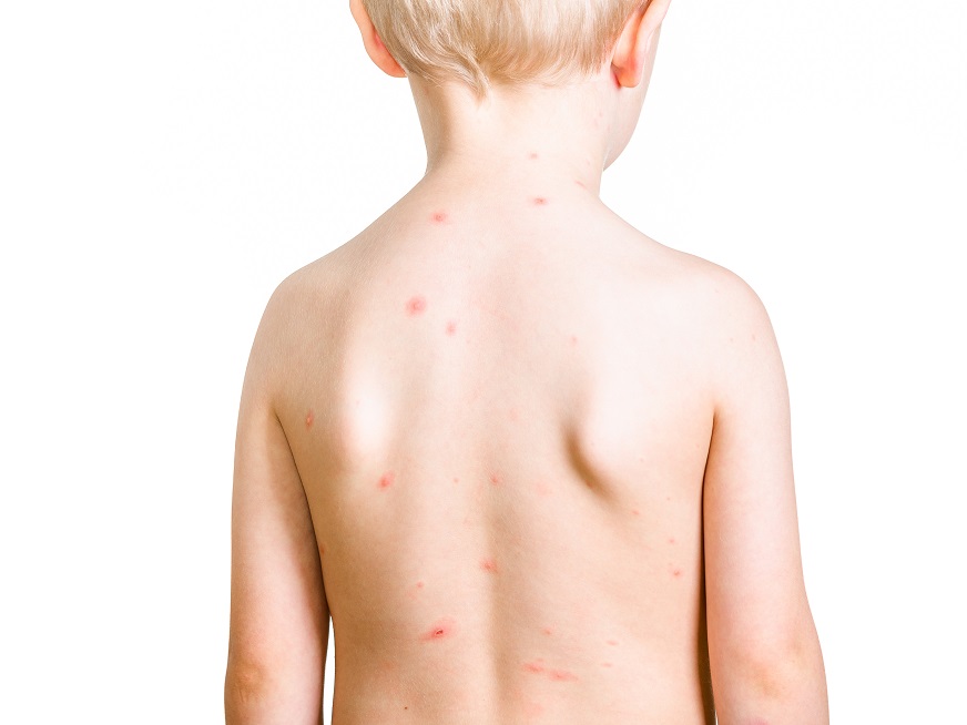 Impétigo, una infección cutánea