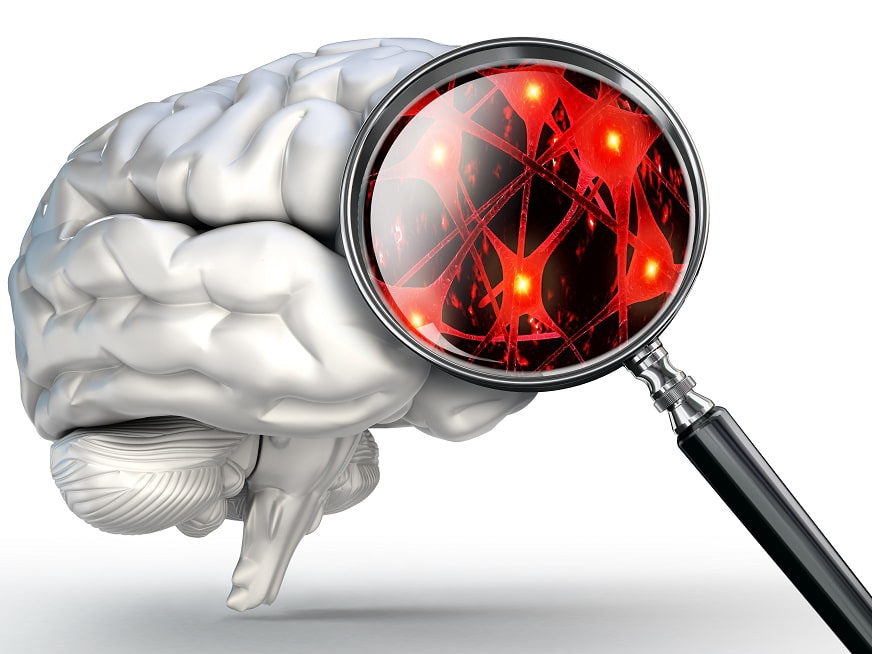 Eco-doppler: Prevenir el ACV