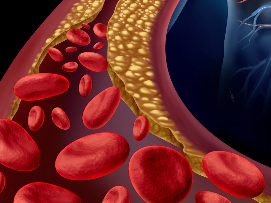 Tromboembolismo Venoso: Frecuente y prevenible