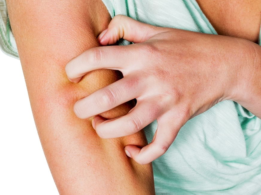 Escabiosis o sarna humana: Evitar el contagio