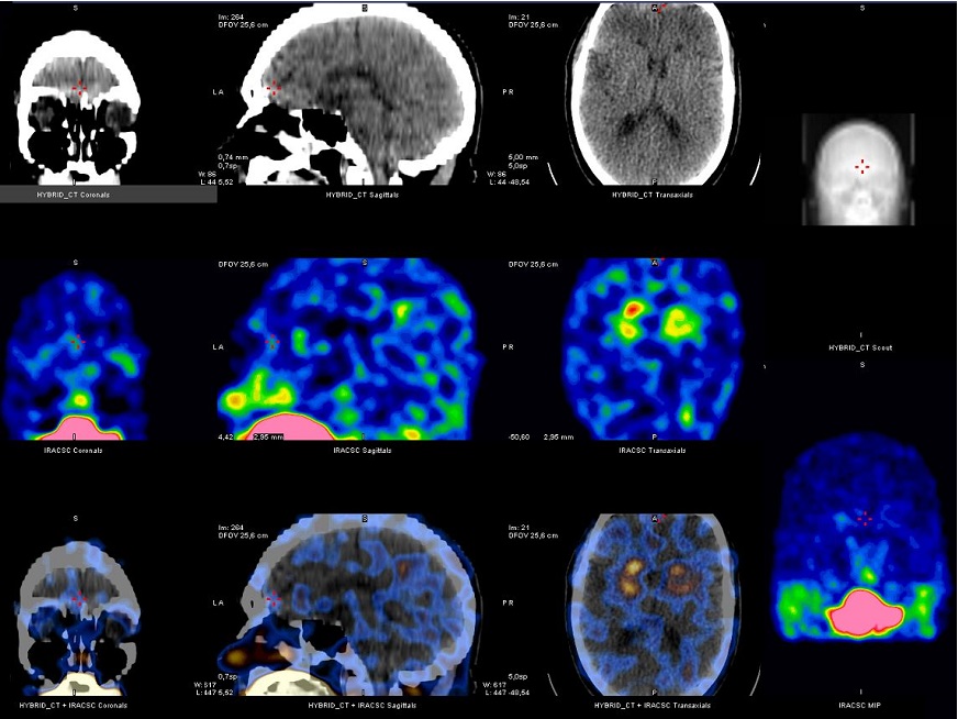 SPECT Cerebral con TRODAT: avance en diagnóstico precoz del Parkinson