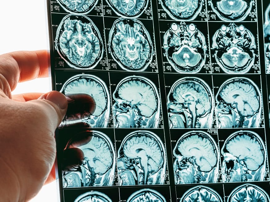 Síntomas de tumores cerebrales