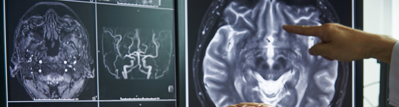 Unidad de Aneurismas y Malformaciones Neurovasculares