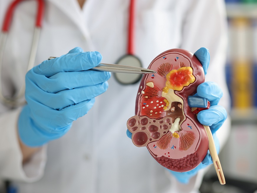 Tumores de Riñón: diagnóstico temprano y tratamiento exitoso