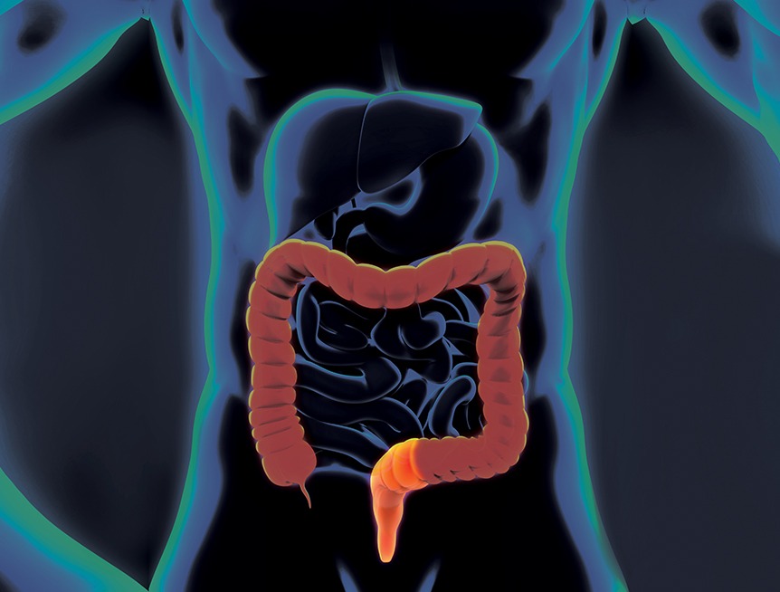 Día Mundial del Cáncer Colorrectal