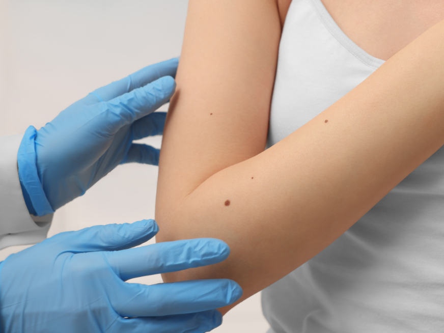 Carcinoma: ¿Qué es? ¿Cómo lo prevenimos?