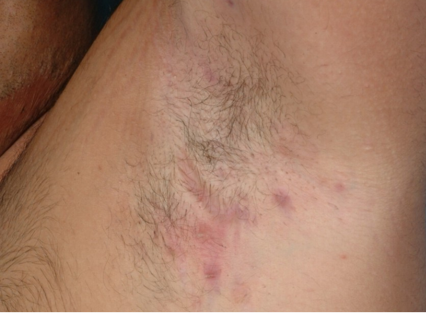 6 de junio: Día Mundial de la Hidradenitis Supurativa