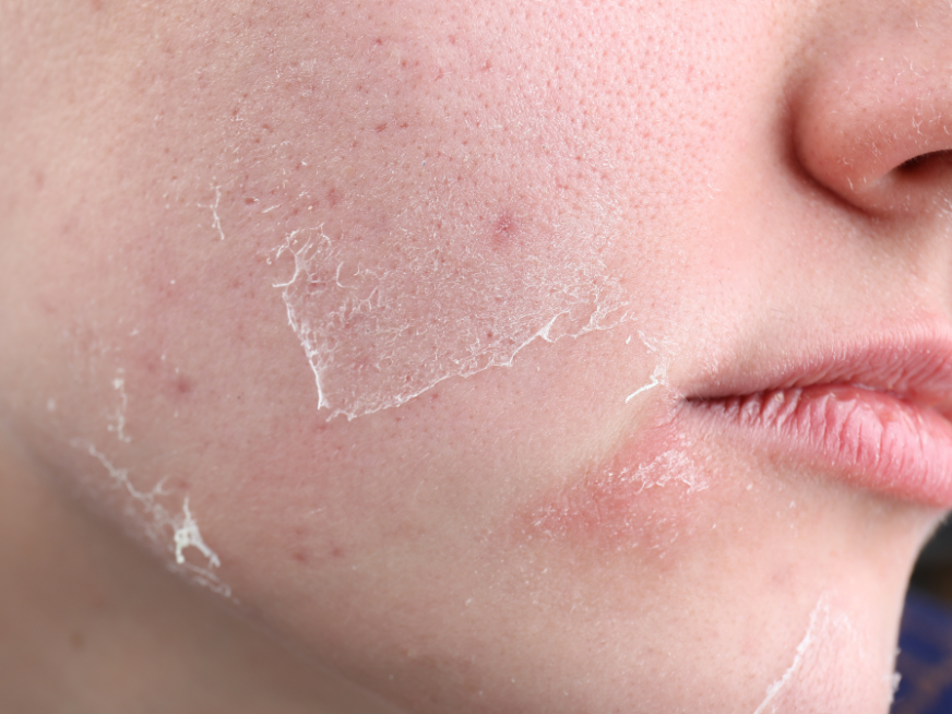 Cómo cuidar la piel en invierno: recomendaciones para prevenir la sequedad y protegerla del frío